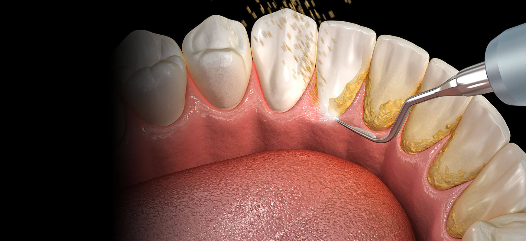 Diş Taşı Temizliği / Tartar Tedavisi